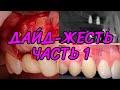 Дайд-жесть? Часть 1: результаты синуса без графта при гайморите и двух пластик рецессий десны