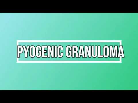 पाइोजेनिक ग्रैनुलोमा: इतिहास, नैदानिक ​​​​और ऊतकीय विशेषताएं (गर्भावस्था ट्यूमर), डीडी और उपचार