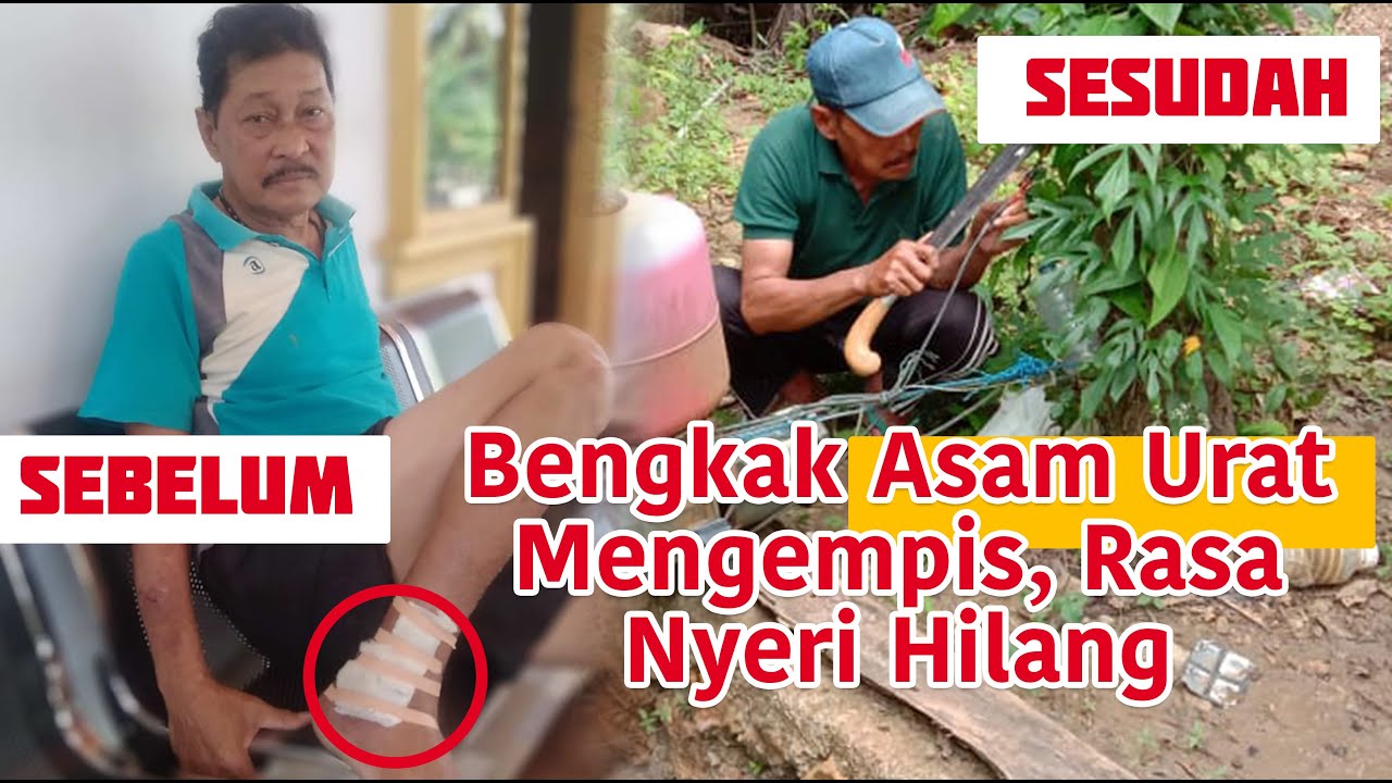 Bengkak Asam Urat Mengempis, Rasa Nyeri Hilang 
