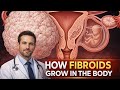 How Fibroids Grow In The Body