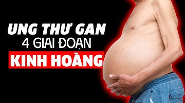 UNG THƯ GAN - 4 GIAI ĐOẠN KINH HOÀNG - ĐỪNG UỐNG RƯỢU NỮA!!
