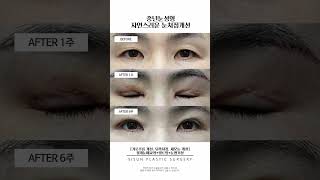 🏳중년눈성형 자연스러운 개선이 중요🏳 #눈썹거상 #시선성형외과 #눈꺼풀처짐