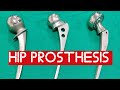 Hip prosthesishemi replacement arthroplastyampthompsonbipolar prosthesis