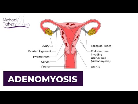 Adenomyosis can be Responsible for Heavy Vaginal Bleeding and Pain