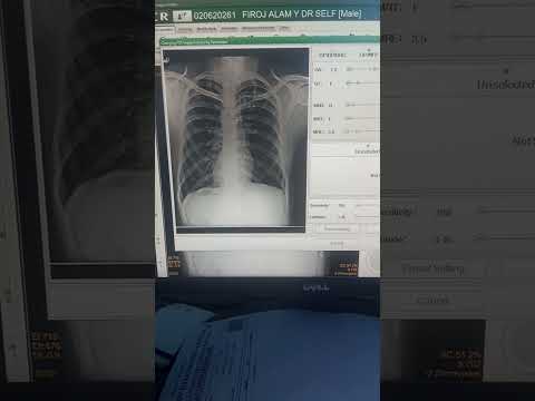 X_Ray chest 🧰🧰🧰🧰🧰 #youtubeshorts #automobile