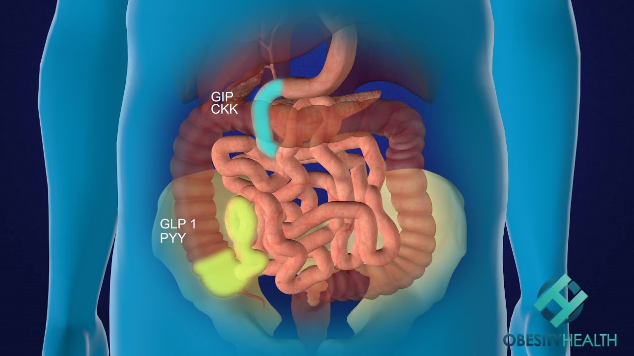 SASI bypass or SASI bipartition animation by Obesity Health S.C.