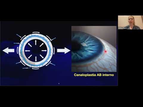 Canaloplastia