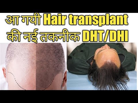 hair-transplant-cost-in-india-||-latest-hair-transplant-technique-||