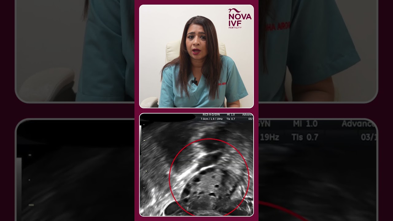 How is ovarian reserve tested explains Dr. Sulbha Arora, Fertility Specialist, Nova IVF Mumbai.
