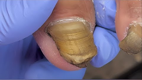 40 Years Without Cutting This Toenail 😳 | Deep Clean Restoration