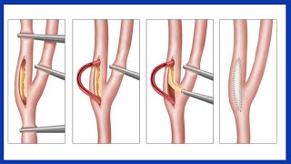 Carotid Endarterectomy