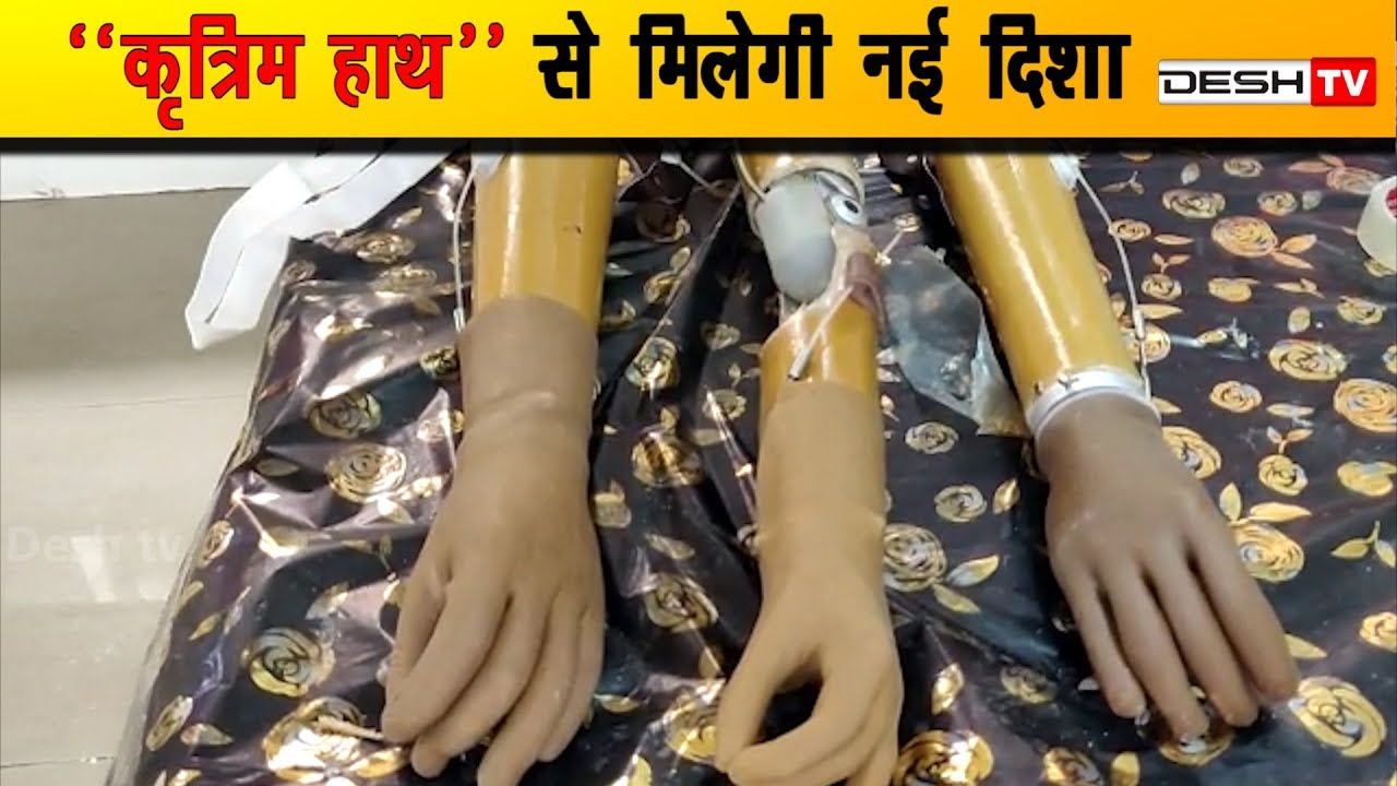 कृत्रिम हाथ से एक नई जिन्दगी की शुरूआत | Prosthetic Hand | Jain Samaj | CG Latest News Today