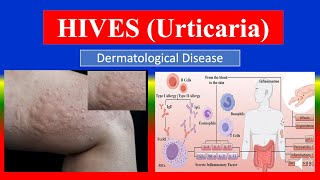 HIVES (Urticaria) - Definition, types, causes, pathophysiology, symptoms , diagnoses , medicine