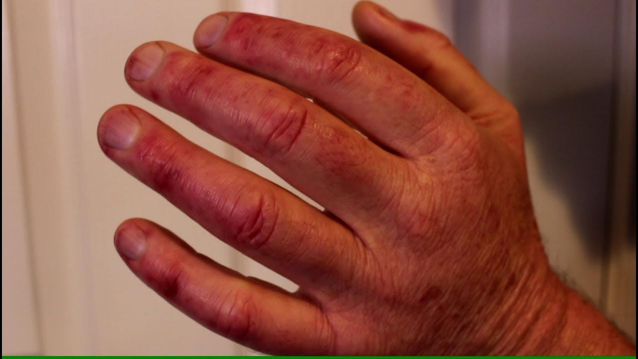 Red Spots And Sore Fingers From Tos Youtube