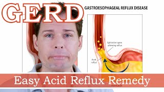 Acid Reflux, Diy Anti-Reflux Remedy, Gaviscon Style Sodium Alginate L-Arginine Hiatal Hernia