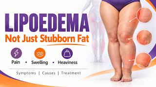 Lipedema Stages Explained | Symptoms, Causes & Treatment Options | Lipedema Treatment in Delhi