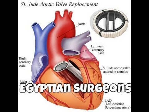 Heart Valve Replacement Part II , Open Heart Surgery