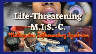 Life Threatening Multisystem Inflammatory Syndrome in Children MIS C Emergency