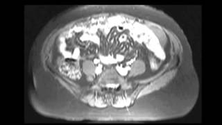 Primary peritoneal carcinomatosis