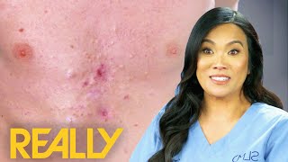 Dr Lee Pops Over 40 Pimples From Patient's Chest | Dr Pimple Popper: Pop Ups