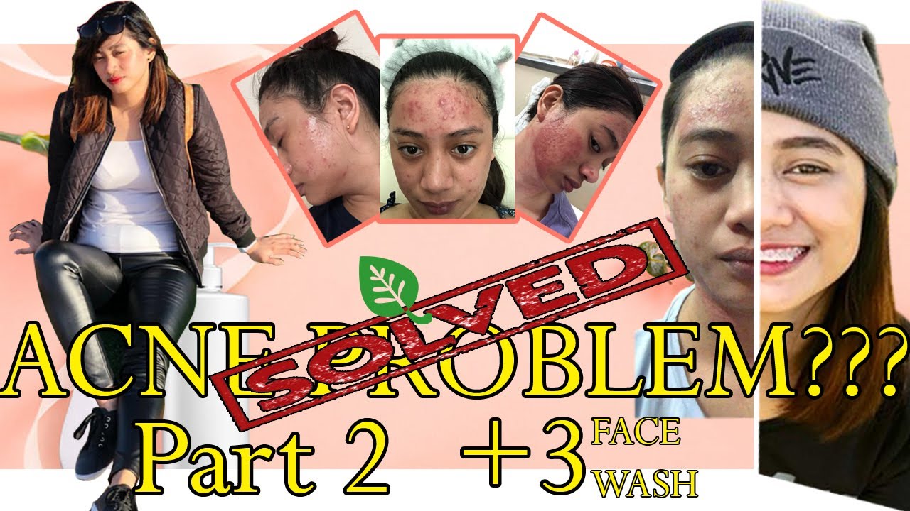 acne treatment tagalog