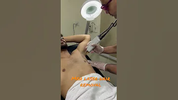 Men Laser Hair Removal For Reservation Call On 00201069001117 