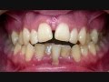 Механика перемещения зубов и стабильность результатов ортодонтического лечения.