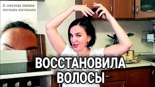 Как я ЛЕЧИЛА ВОЛОСЫ после ковида