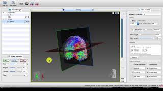 MI-Brain - Flip streamlines