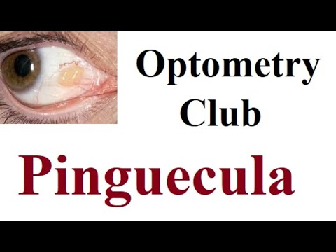 Video: Pinguecula: Identifizierung, Ursachen Und Symptome