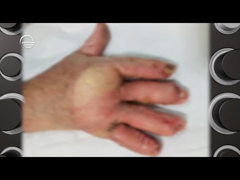 ქირურგიული ოპერაციებით შენარჩუნებული ხელის მტევანი