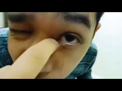 Video: „Goopy Eyes“: Priežastys Ir Gydymas