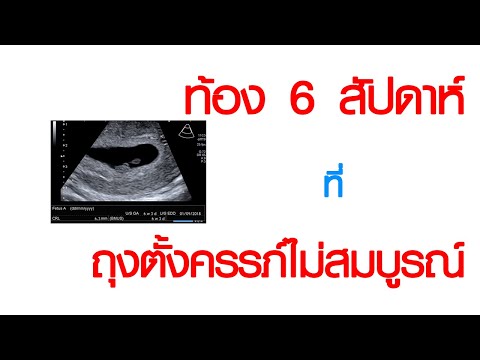 พบหมอเสรี ตอนที่ 724 : ตั้งครรภ์ 6 สัปดาห์ที่ถุงตั้งครรภ์ไม่สมบูรณ์