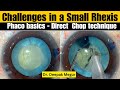 Phaco basics  direct chop challenges in a small rhexis  dr deepak megur