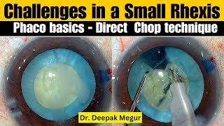 Phaco Basics - Direct Chop Challenges In A Small Rhexis - Dr Deepak Megur