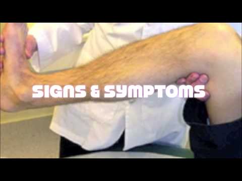 Cibo e trattamento di thrombophlebitis delle estremità più basse