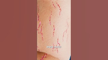 How Stretch Marks Appear 😮 Surgeon Reacts