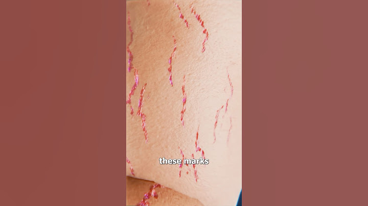 How Stretch Marks Appear 😮 Surgeon Reacts