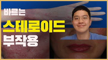 사진으로 보는 스테로이드 부작용 (연고,로션,크림..) [피부의 모든 것 덤덤TV]