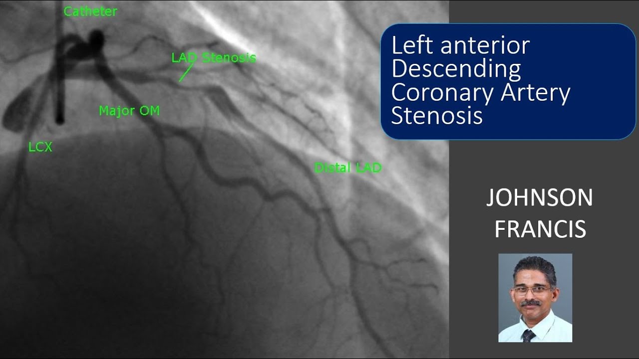 Diagonal Branch Of Left Anterior Descending
