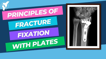 Biomechanics of Fracture Fixation | Intramedullary Nails and Plates & Screws | Orthopaedic Academy