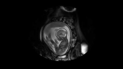 MRI scan at 28 weeks