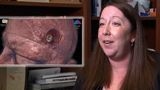 Woman relieved after 'brain tumor' turns out to be parasite