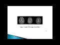 Segmentation of Multiple Sclerosis Lesion in Brain MR Images Using Fuzzy C-Means