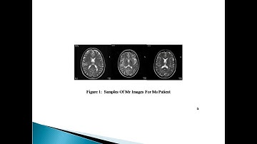Segmentation of Multiple Sclerosis Lesion in Brain MR Images Using Fuzzy C-Means