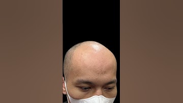 Ánh sáng cho người hói đầu  xăm tóc tuyệt vời #reviewxămtóc #hói_đầu #xămchântóc