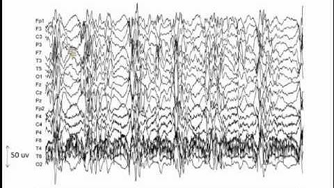Pharmacologically induced coma: Neurophysiology and closed-loop control