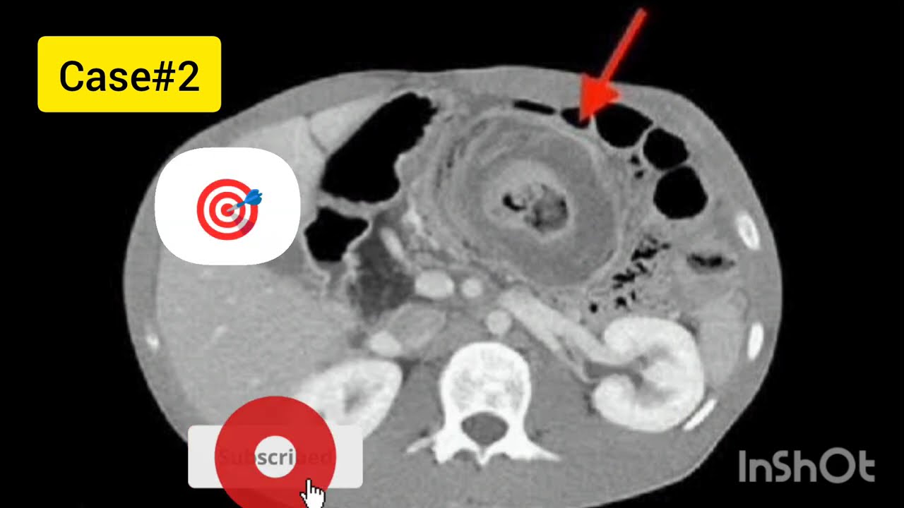 5 CT Scan Signs You Must Know (Abdominal Emergencies) 🏥