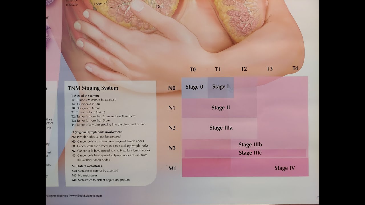 Cum este diagnosticat cancerul mamar - Stadializare și clasificare pentru cancerul mamar