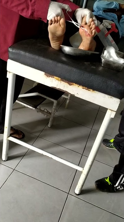 #2019 #Ngeri# Mencabut #Paku yang nancap di kaki..